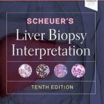 Scheuer’s Liver Biopsy Interpretation
